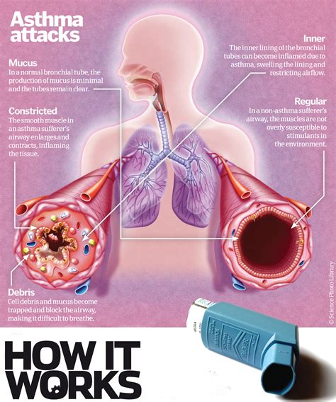 asthma   difficult  breathe   works