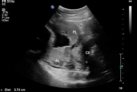 ultrasound placenta previa   embryology