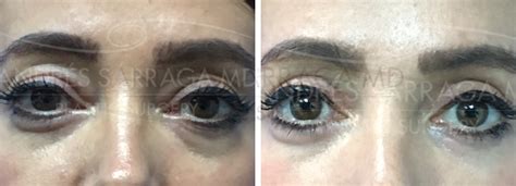 Eyelid Surgery Sarraga