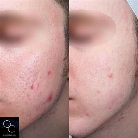 acne scarring treatment doctor quinn clinics bristol