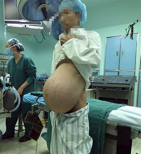 Chinese Man Who Looked Pregnant For Years Has Massive