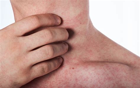 alergia na pele   causa sintomas  tratamentos atualizado