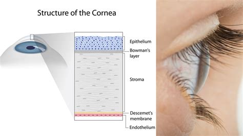 cornea treatment long beach socal eye