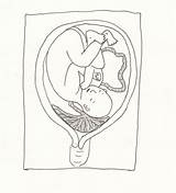 Previa Placenta sketch template