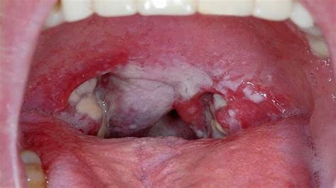 Signs Of Strep Throat Full Real Porn