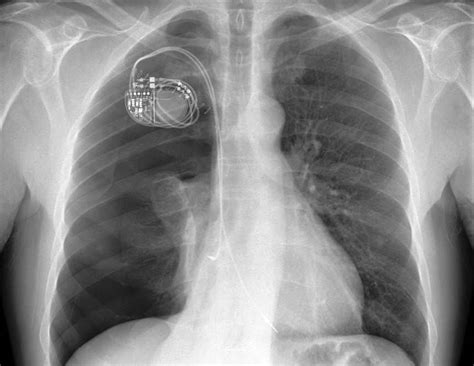 pacemaker  buyxraysonline