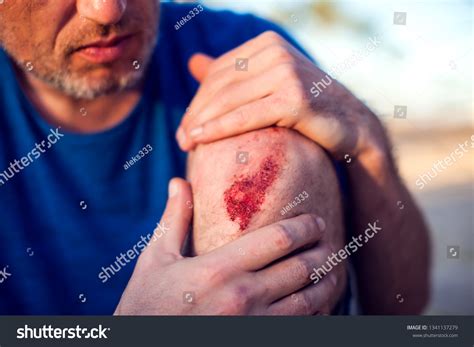 infection  abrasion   skin immagini foto stock  grafica
