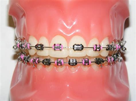 pink colored braces in 2020 pink braces braces getting braces