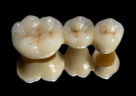 crown bridge dentistry dental planets
