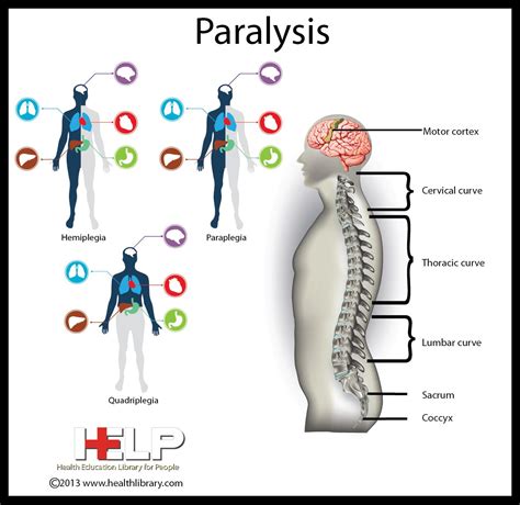 medical definition  paralysis definition fgd