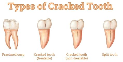 chipped  cracked teeth treatments  melbourne  dental check