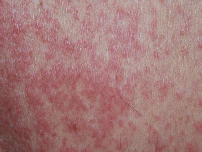 rode vlekken op de huid oorzaken met fotos huidinfonl dermatoloog