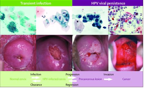 Major Steps In The Development Of Cervical Cancer Top Row Shows
