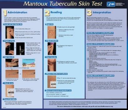 cdc tb skin test form