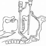 Adenoidectomy Endoscopic Debrider Adenoid sketch template