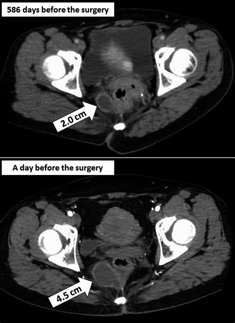robot‐assisted excision of rectal duplication cysts a case report