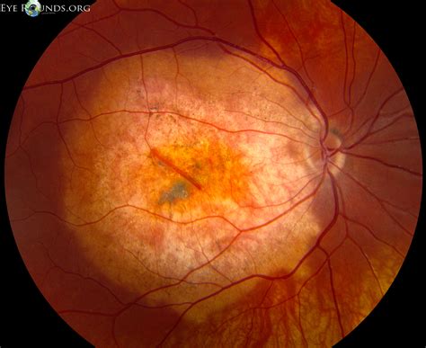 Choroidal Osteoma Online Atlas Of Ophthalmology The