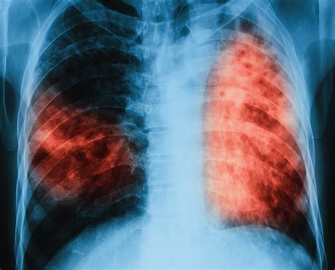 tuberculosis infections declining   fast