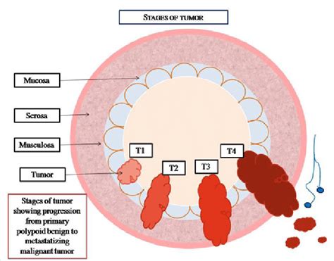 Colon Cancer Treatment Colorectal Cancer Stages And Treatment Options