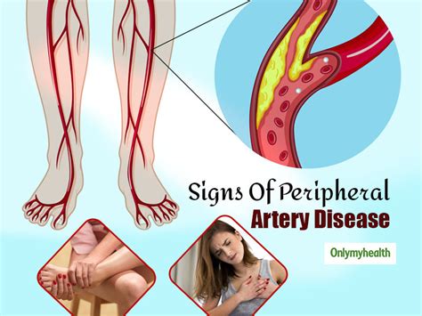 peripheral artery disease acute pain  chest  leg  signs  pad