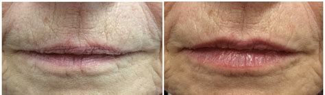 lip rejuvenation and treatments for lip lines by dr teri johnson