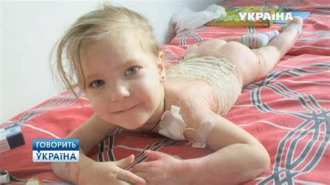 Обожженная девочка на миллион полный выпуск Говорить Україна youtube