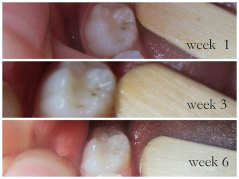 photographic proof cavities heal healthy home economist
