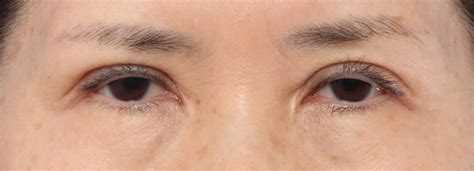 a plastic surgeon s guide on ptosis eyelid surgery in singapore dream