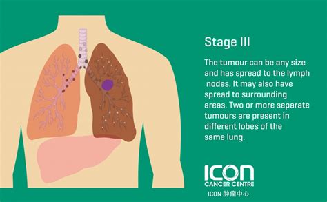 What Is Lung Cancer Symptoms And Causes Icon Cancer Center China