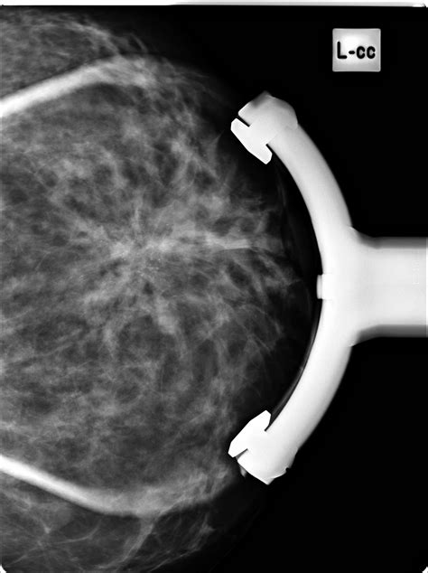 invasive ductal breast carcinoma image
