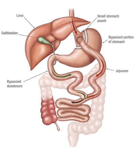Gastric Bypass Surgery Everything You Need To Know Dr