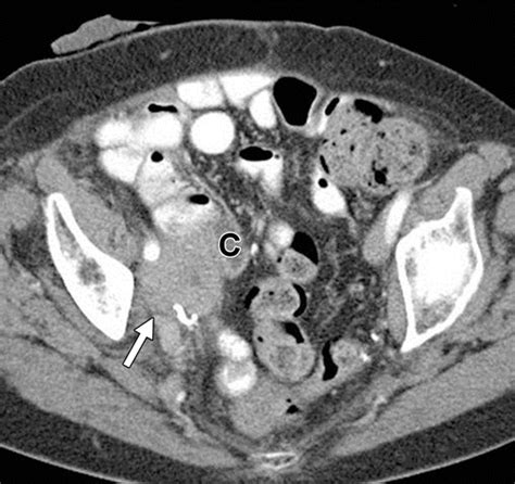follow the stream imaging of urinary diversions radiographics