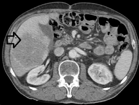 cureus resection  large metachronous liver metastasis  gastric origin case report