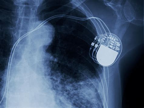 pacemakers  implantable defibrillators medlineplus