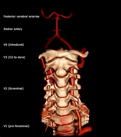 Vertebral Artery Test Physiopedia