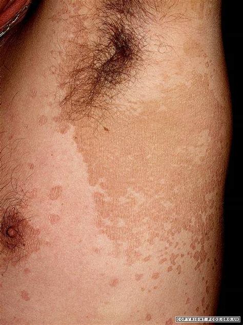 Scaly Rashes Common Primary Care Dermatology Society Uk