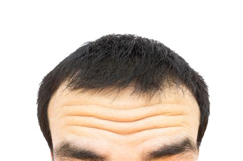 risky wrinkles study finds deep forehead wrinkles   linked