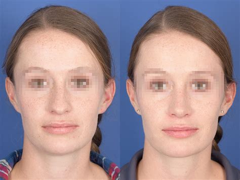Rhinoplasty Before And After 82 Weber Facial Plastic Surgery