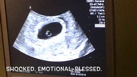 6 weeks 4 days twins ultrasound