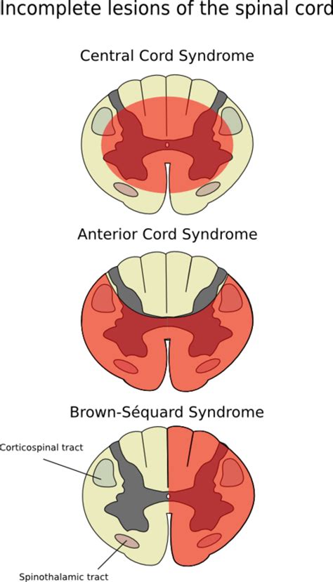 Central Cord Syndrome Physiopedia