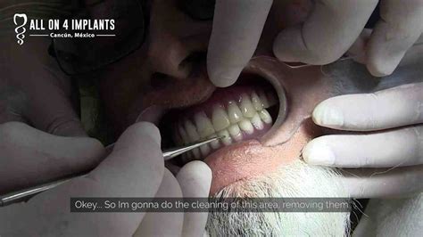 polish dental implants dental news network