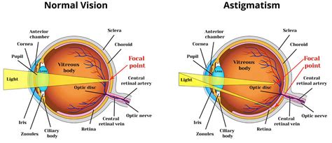 astigmatism  symptomstreatment