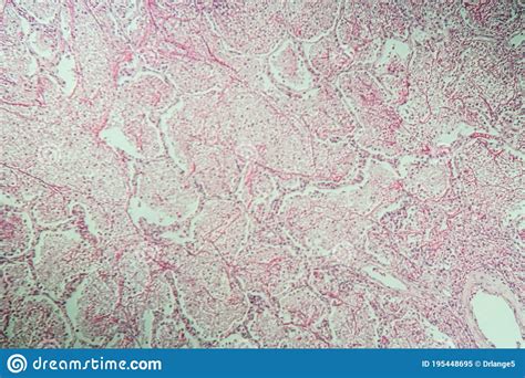 inflamed tissue   microscope stock image image  pathology