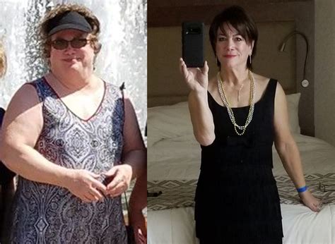 Lynn S Weight Loss Transformation St Louis Bariatrics