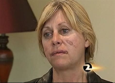 wtf woman attempts plastic surgery on her own face plastic surgery