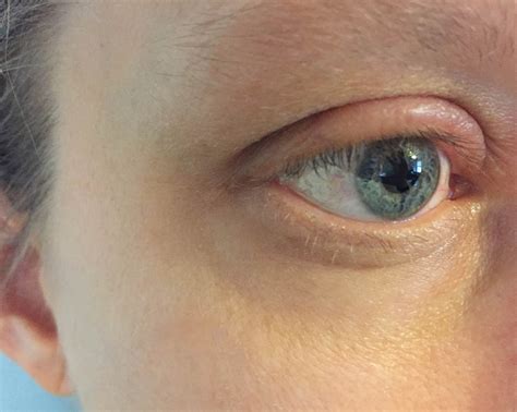 upper eyelid swelling