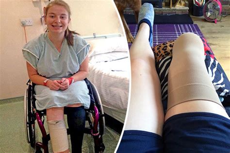 Brave Teen Girl Pays To Have Leg Amputated – Because Of Ingrowing