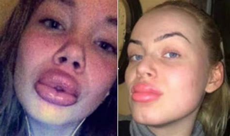 Plastic Surgery Fails 8 Lip Enhancements Gone Wrong Oddee