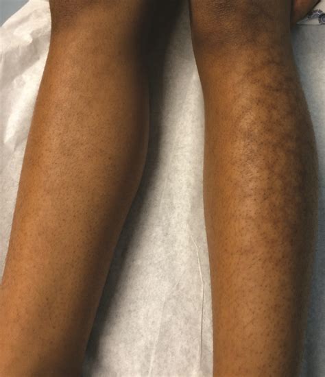 List 94 Pictures Leg Discoloration Due To Poor Circulation Pictures Superb