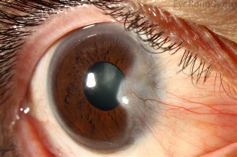 Pterygium Online Atlas Of Ophthalmology The University
